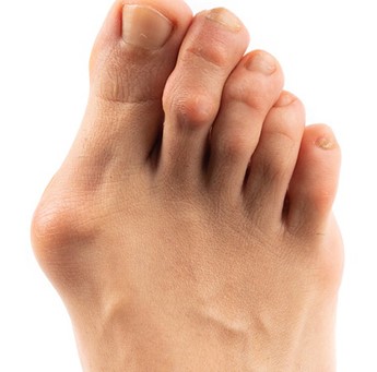Hallux valgus Loopvisie